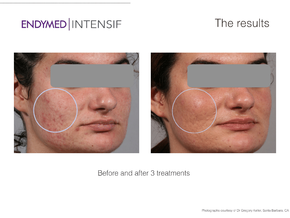 before and after EndyMEd Intensif