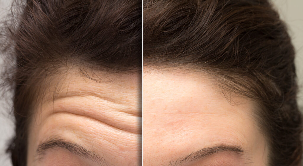 before and after a botox treatment