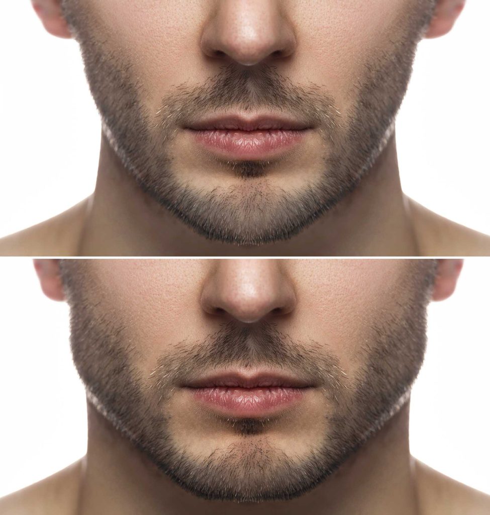 Jawline Dermal Filler Estheva Medical Aesthetic Clinic