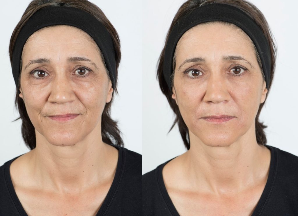 Tear Trough fillers Estheva Medical Aesthetic Clinic