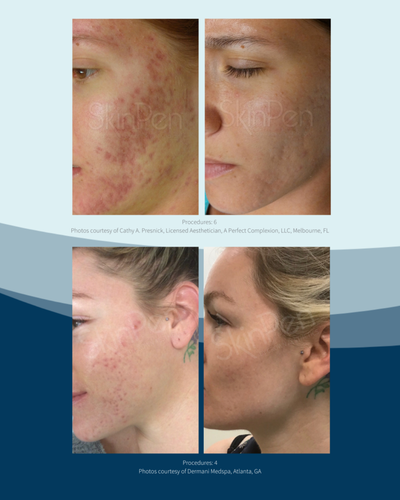 Acne scarring micro needling with SkinPen