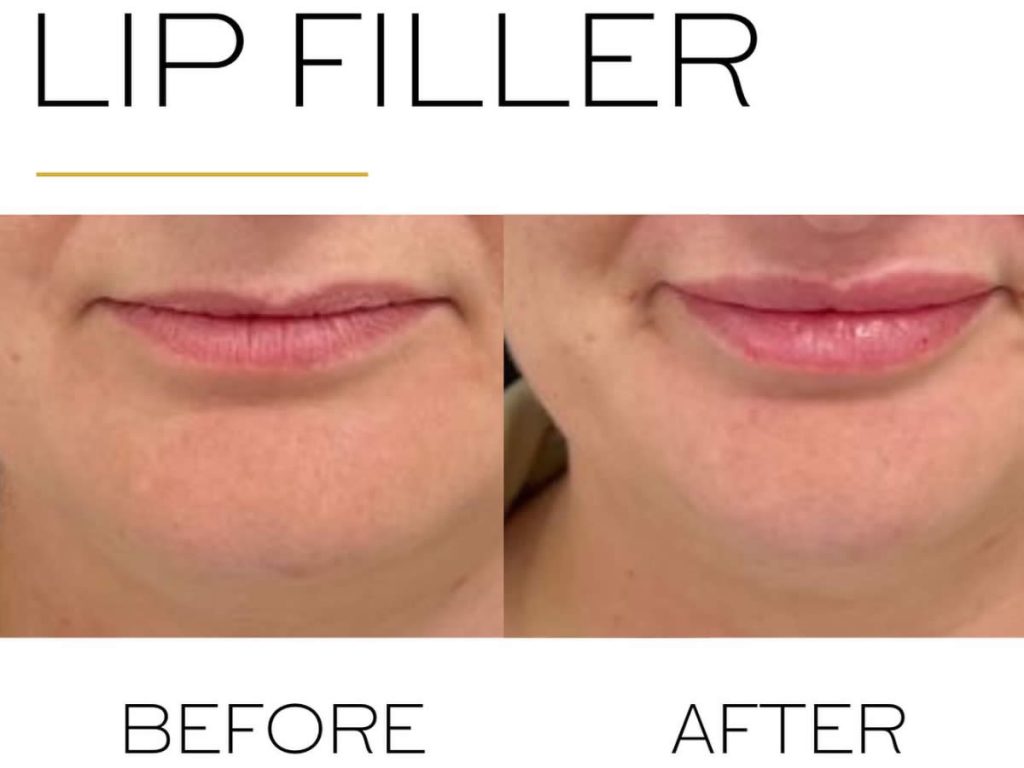 lip filler before and after