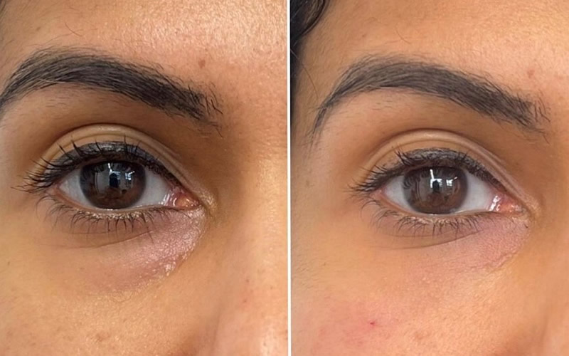 Ameela Polynucleotide Estheva Medical Aesthetic Clinic