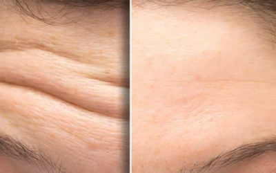 Explaining the Benefits of Botox®
