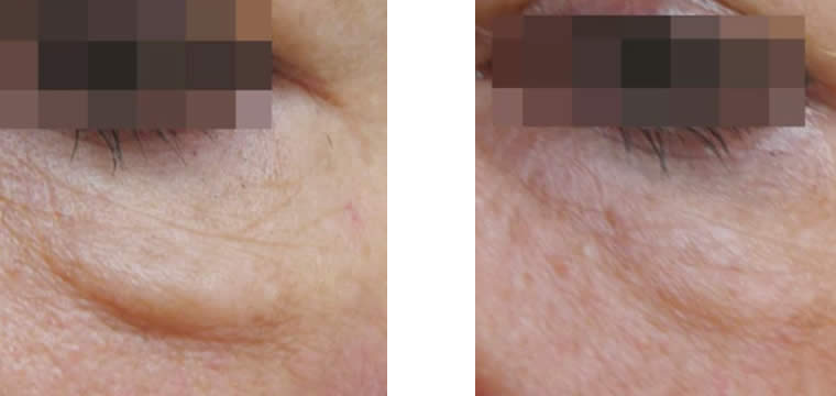 endybleph before and after