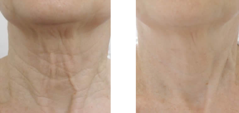 endybleph tighten before and after