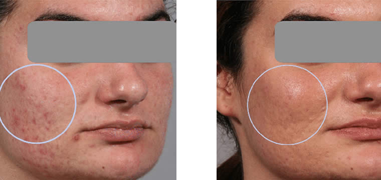 intensif before and after