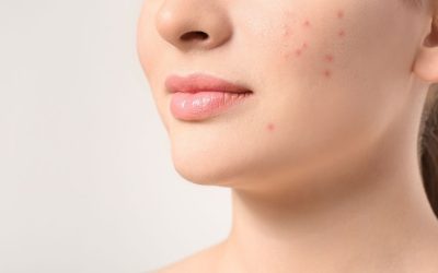 5 Common Skin Problems and their Treatments