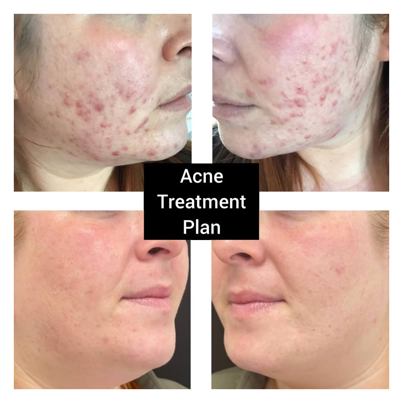 acne treatment stirling