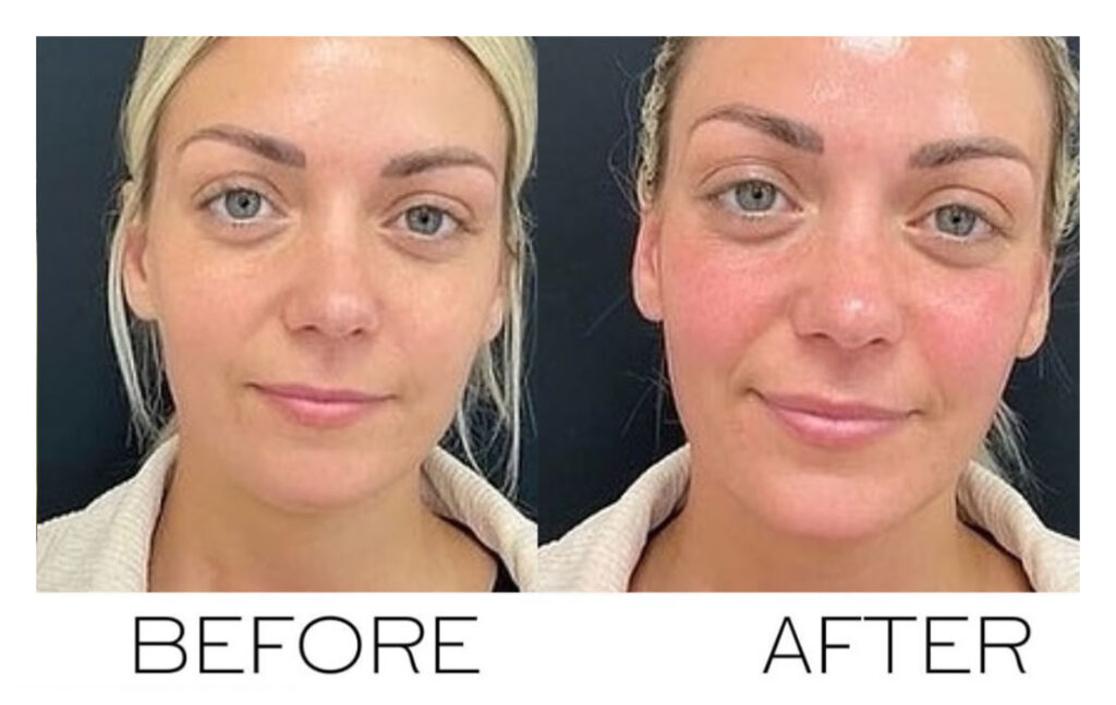 hydrafacial before and after