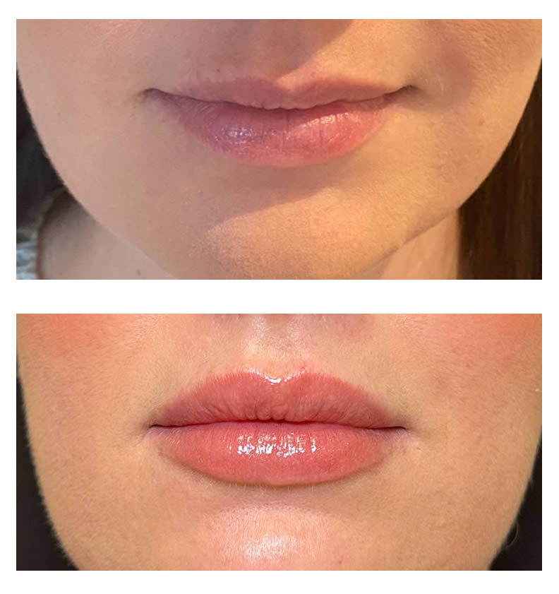 lip filler before and after