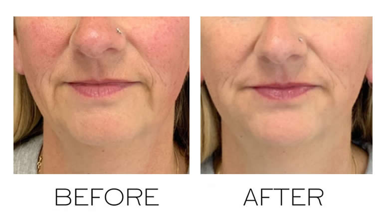 marionette lines before after