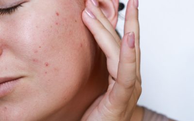 Add Laser Skin Resurfacing To Your Christmas List