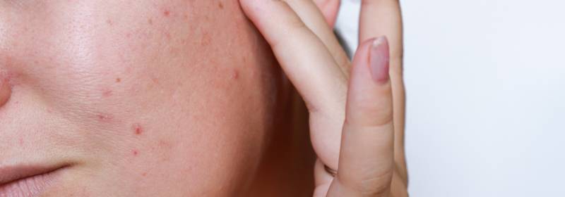 laser skin resurfacing stirling