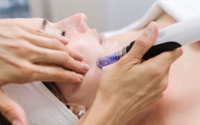 Microneedling at Estheva
