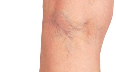 Thread Vein Treatment at Estheva