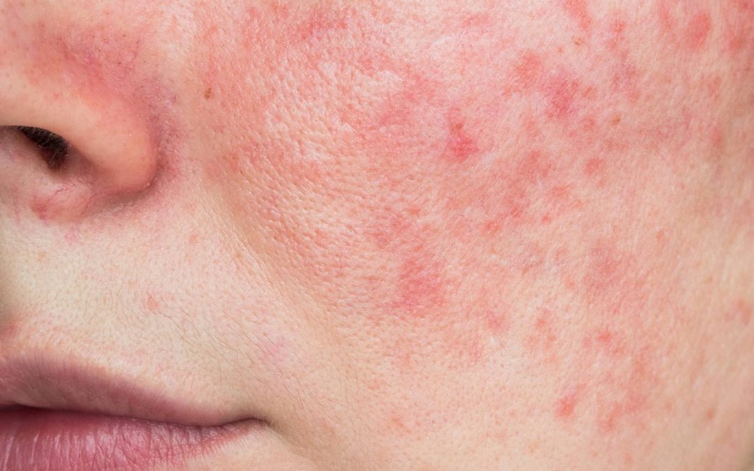 Why Your Acne Keeps Coming Back And How To Treat It Properly