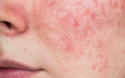 Why Your Acne Keeps Coming Back And How To Treat It Properly