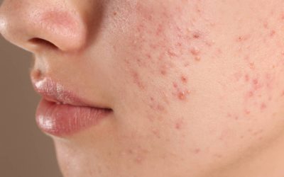 AviClear Acne Treatment at Estheva A New Approach to Clearer Skin