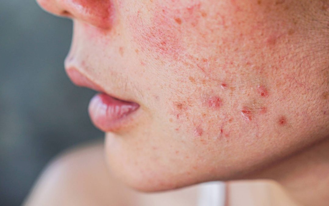 Problem Skin. Why It Happens and How Professional Treatments Can Help