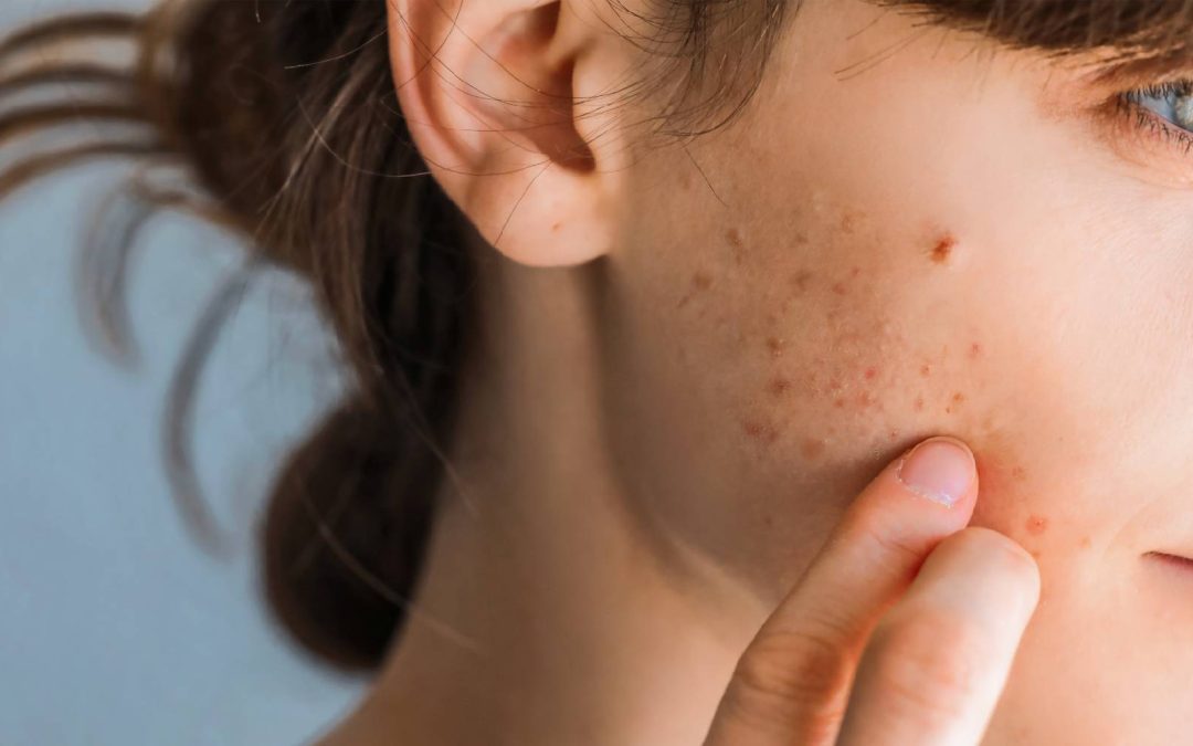 Estheva, Acne Specialists in Scotland