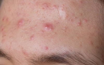 Acne Treatment For a Clearer Summer