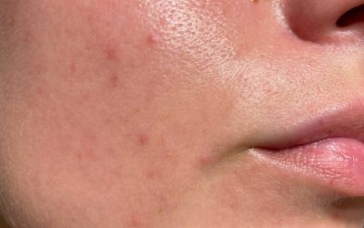 Non Injectable Skin Treatments in Stirling