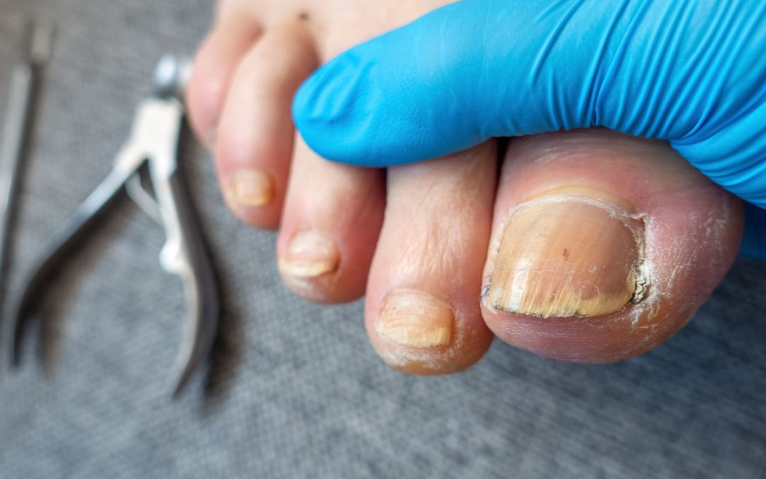 fungal nail treatment in Stirling