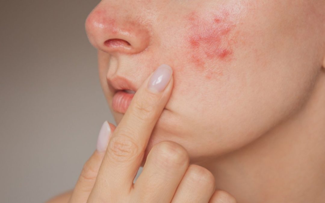 AviClear Treatment in Stirling: What to Expect Before, During and After