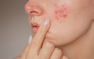 AviClear Treatment in Stirling: What to Expect Before, During and After